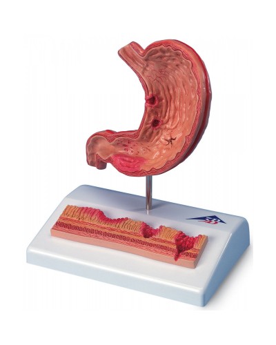 Модель желудка с язвами, 2 части